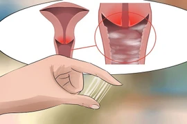 Đi khám viêm phụ khoa, bất ngờ phát hiện mắc tiền ung thư cổ tử cung