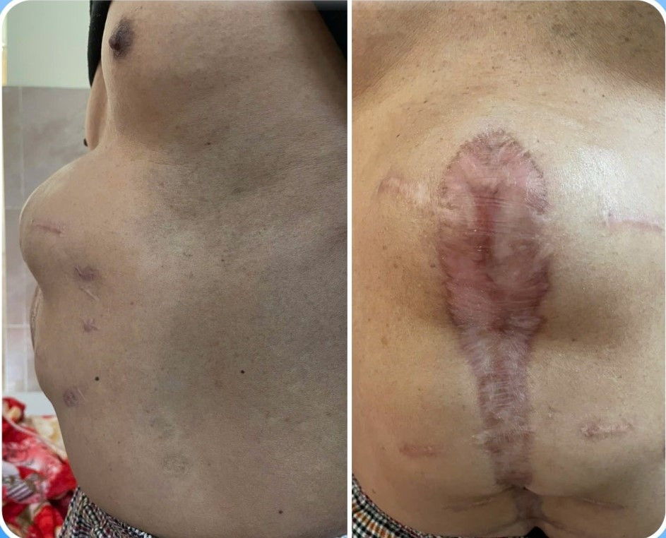 Khối thoát vị "khổng lồ" trên bụng bệnh nhân - Ảnh BVCC khoi-thoat-vi-cpc-3-9853.jpg