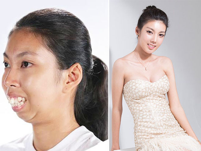 Nhớ hồi năm ngoái, cô gái có tên Wijitpraphorn Punbu khiến báo chí tốn không ít giấy mực vì "dậy thì thành công" nhờ phẫu thuật thẩm mỹ. Cô vốn sở hữu ngoại hình xấu xí, gương mặt không cằm và hàm răng hô, chen chúc nhau. Trong quá khứ, Punbu thường xuyên bị chế nhạo, giễu cợt, tự ti đến mức không dám gặp ai. Không chỉ kém xinh, gương mặt méo mó còn khiến cô mắc tật gáy to, không thể ăn uống bình thường và bị bệnh tiêu hóa.