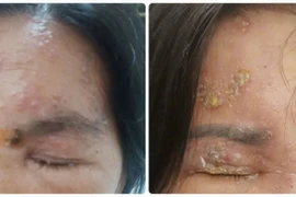 Vắc xin Zona, lá chắn phòng bệnh hiệu quả cho người bệnh nền