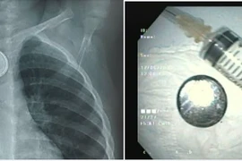 Dị vật cực nguy hiểm gây loét thực quản trẻ 18 tháng